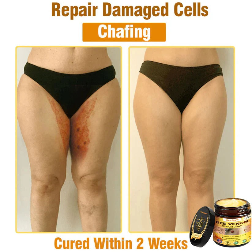 đ„FDA Approved: Bee Venom Skin Restoration Cream â đ„Limited Time 80% OFFđ„
