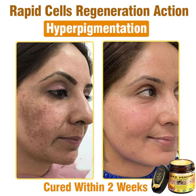 đ„FDA Approved: Bee Venom Skin Restoration Cream â đ„Limited Time 80% OFFđ„