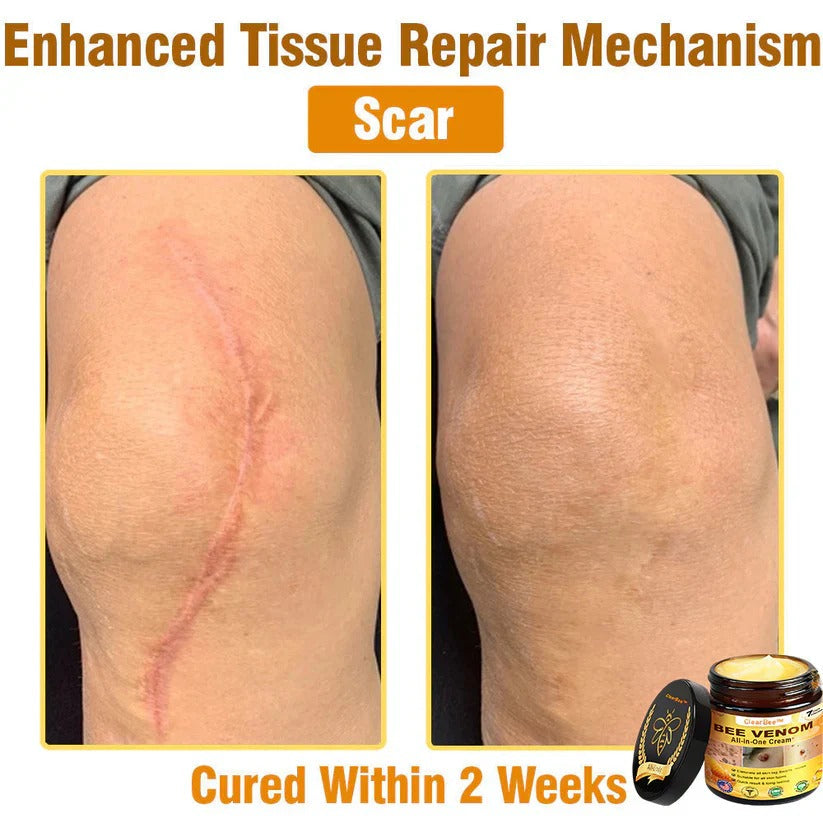 đ„FDA Approved: Bee Venom Skin Restoration Cream â đ„Limited Time 80% OFFđ„