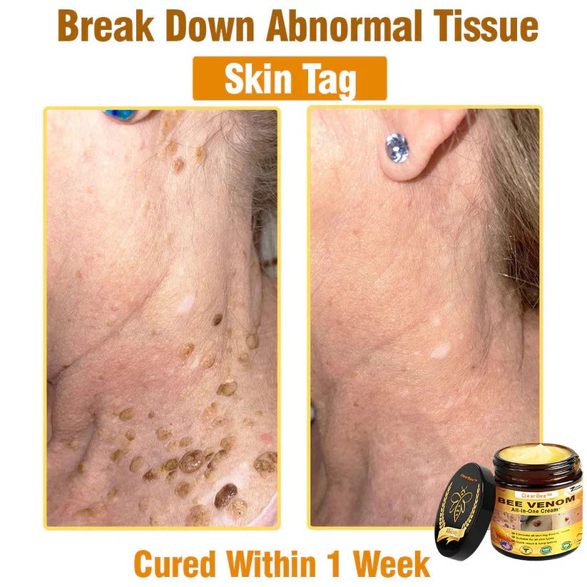 đ„FDA Approved: Bee Venom Skin Restoration Cream â đ„Limited Time 80% OFFđ„